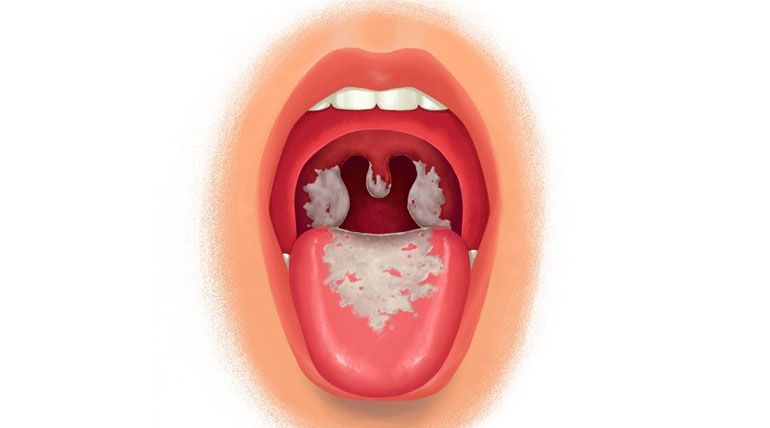 Triệu chứng dễ nhận biết của bệnh bạch hầu